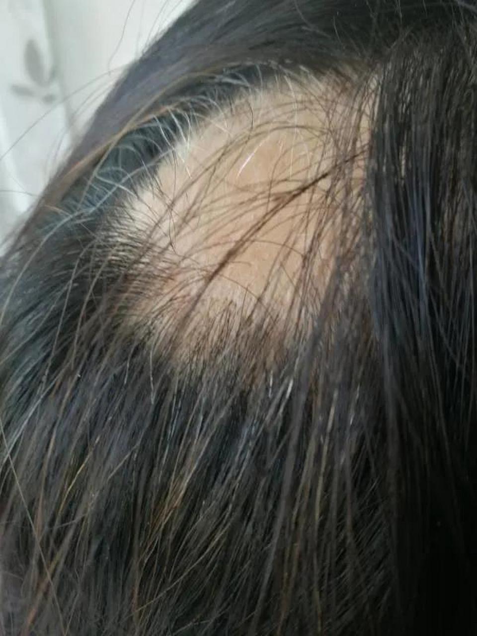 女性斑秃不可怕,好好治疗能恢复.  记得43岁时,身体开始进入紊乱期.