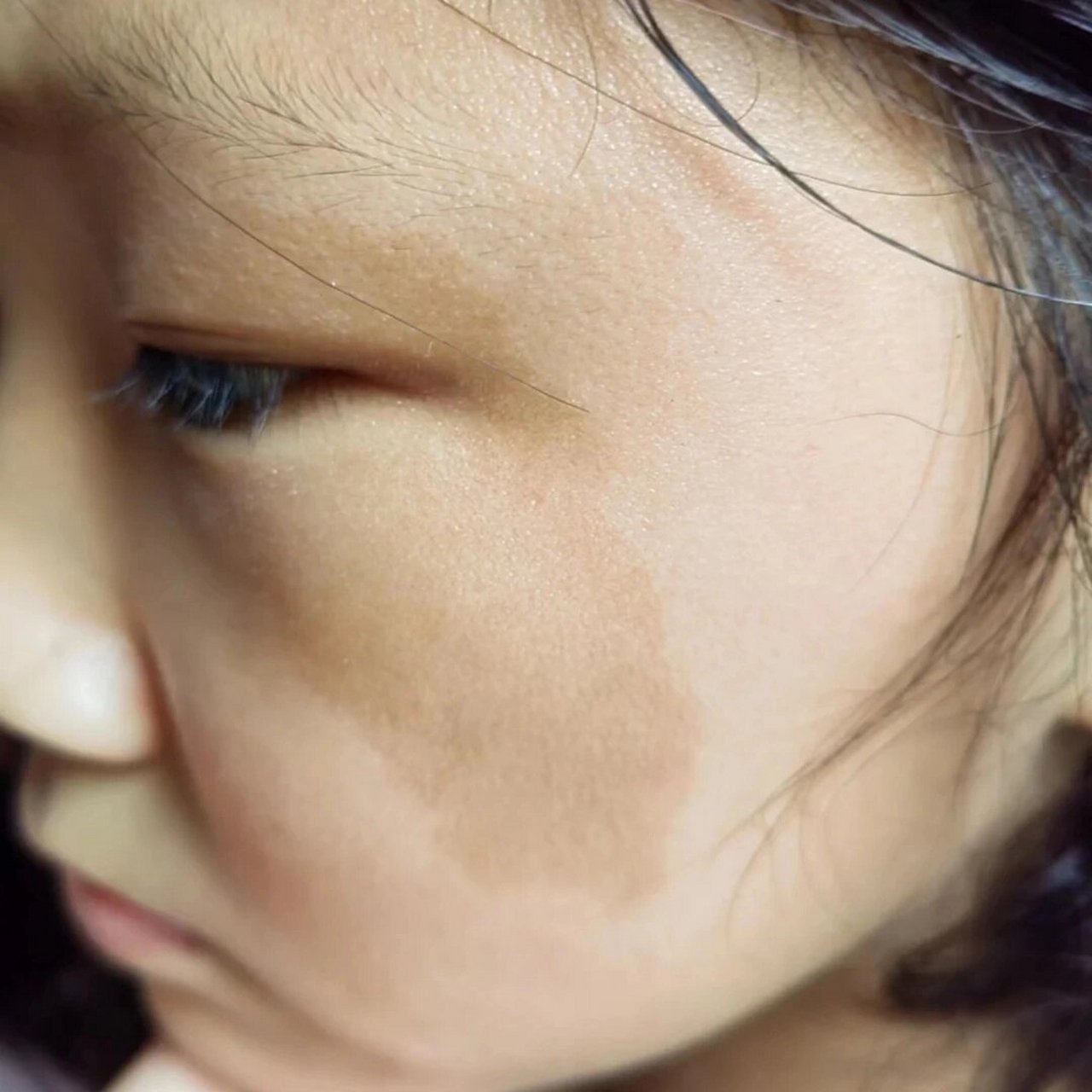 97宝宝咖啡斑会自己消失吗96 咖啡斑一旦形成,会随着身体不断长大