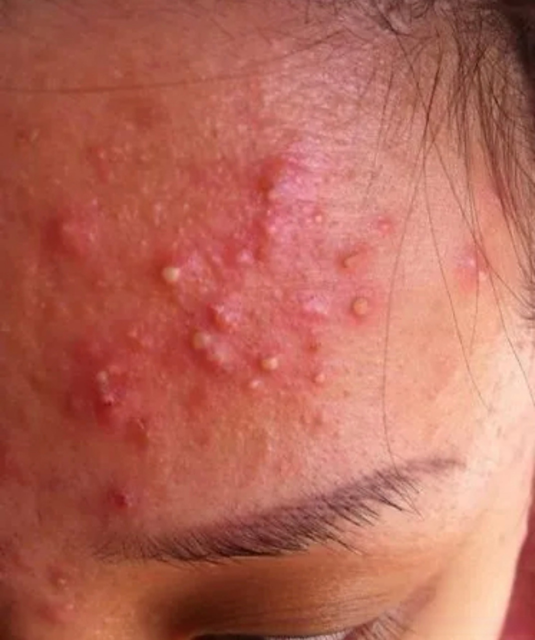 过了青春期为什么还长痘#护肤知识充电站# [微风]过了青春期还长痘痘