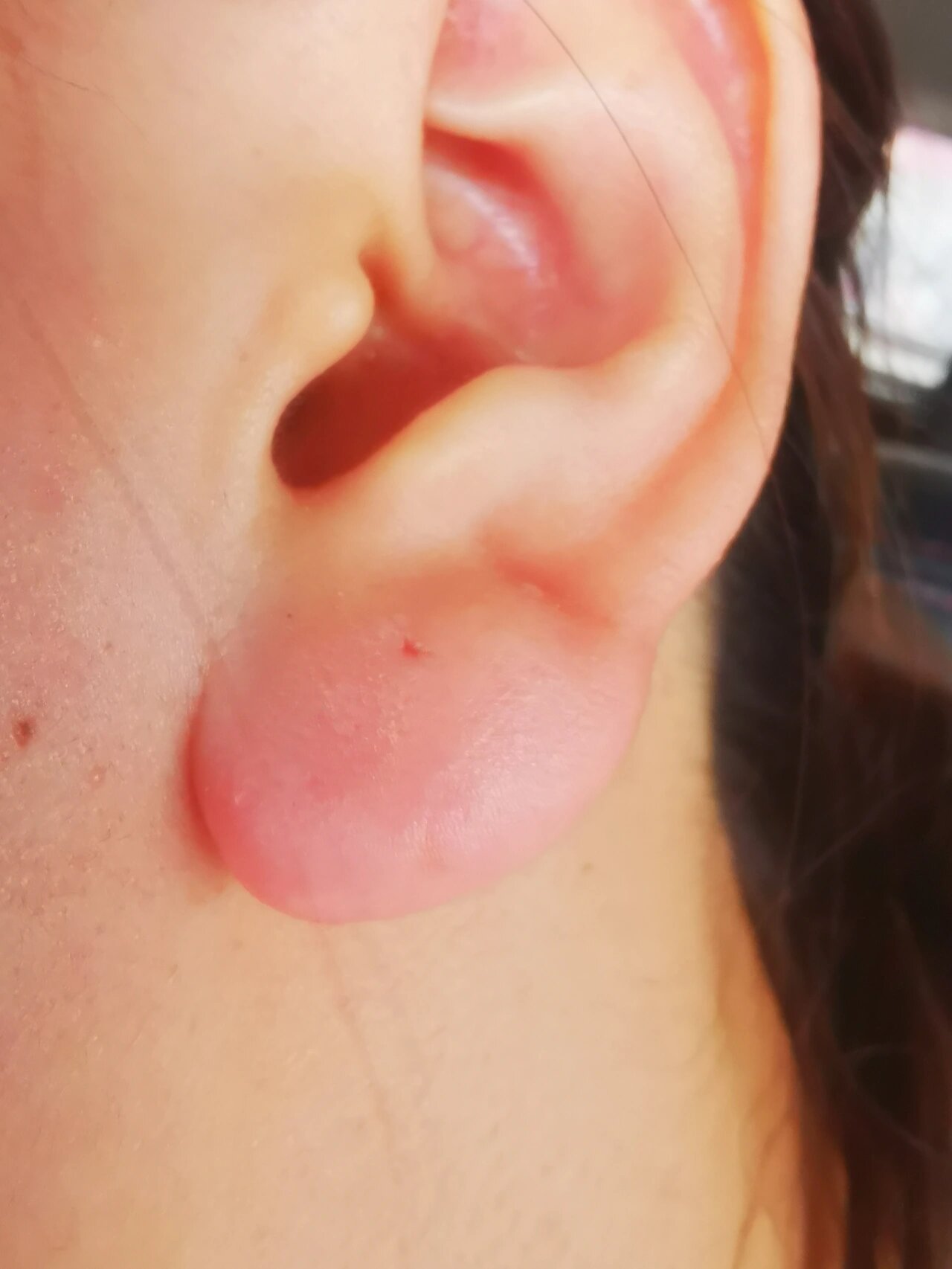 有跟我一样耳垂经常又痛又肿的吗?咋搞