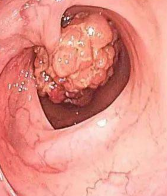 最常见的是大便干结,也可能是结肠肿瘤或降结肠,乙状结肠的肿瘤导致