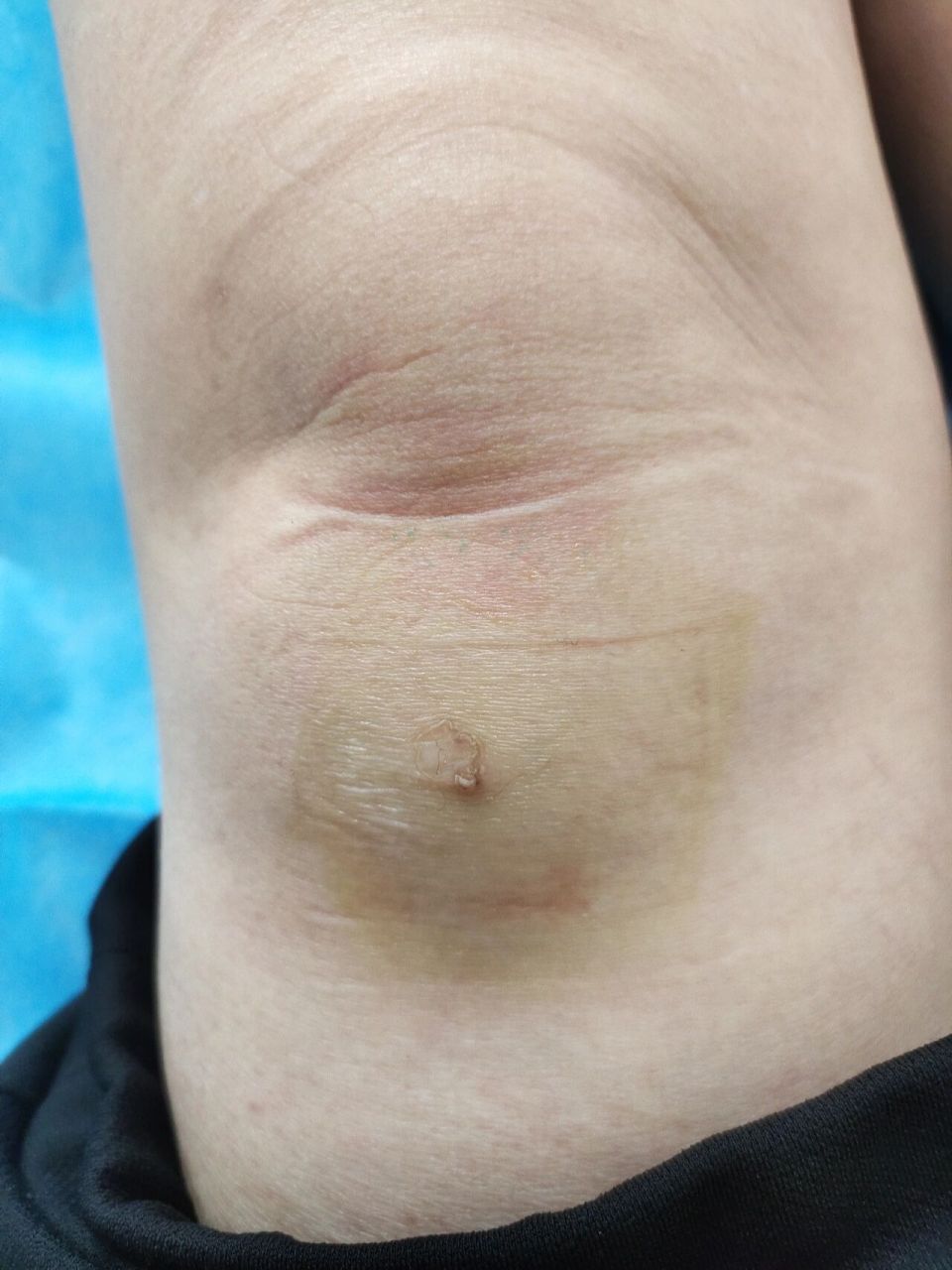 环状肉芽肿 环状肉芽肿是一种少见的良性炎症性皮肤病.