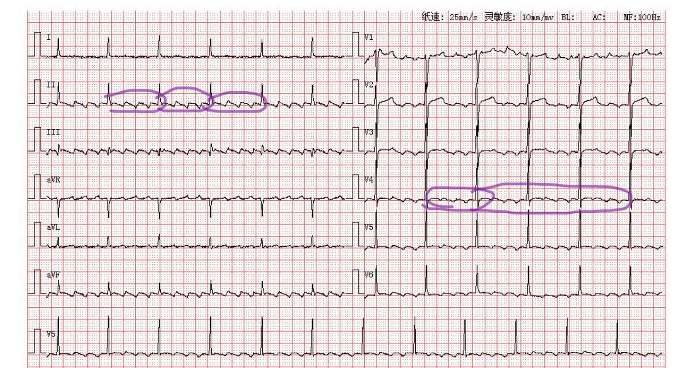 t波异常 	 分析:如图可知,患者p波消失,取而代之以规则频率的f波,呈4