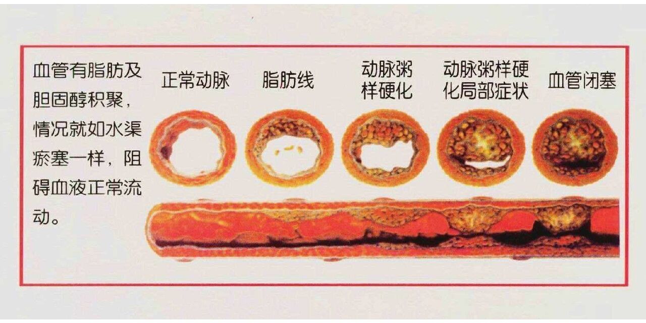 胖人的血管脂肪图片图片