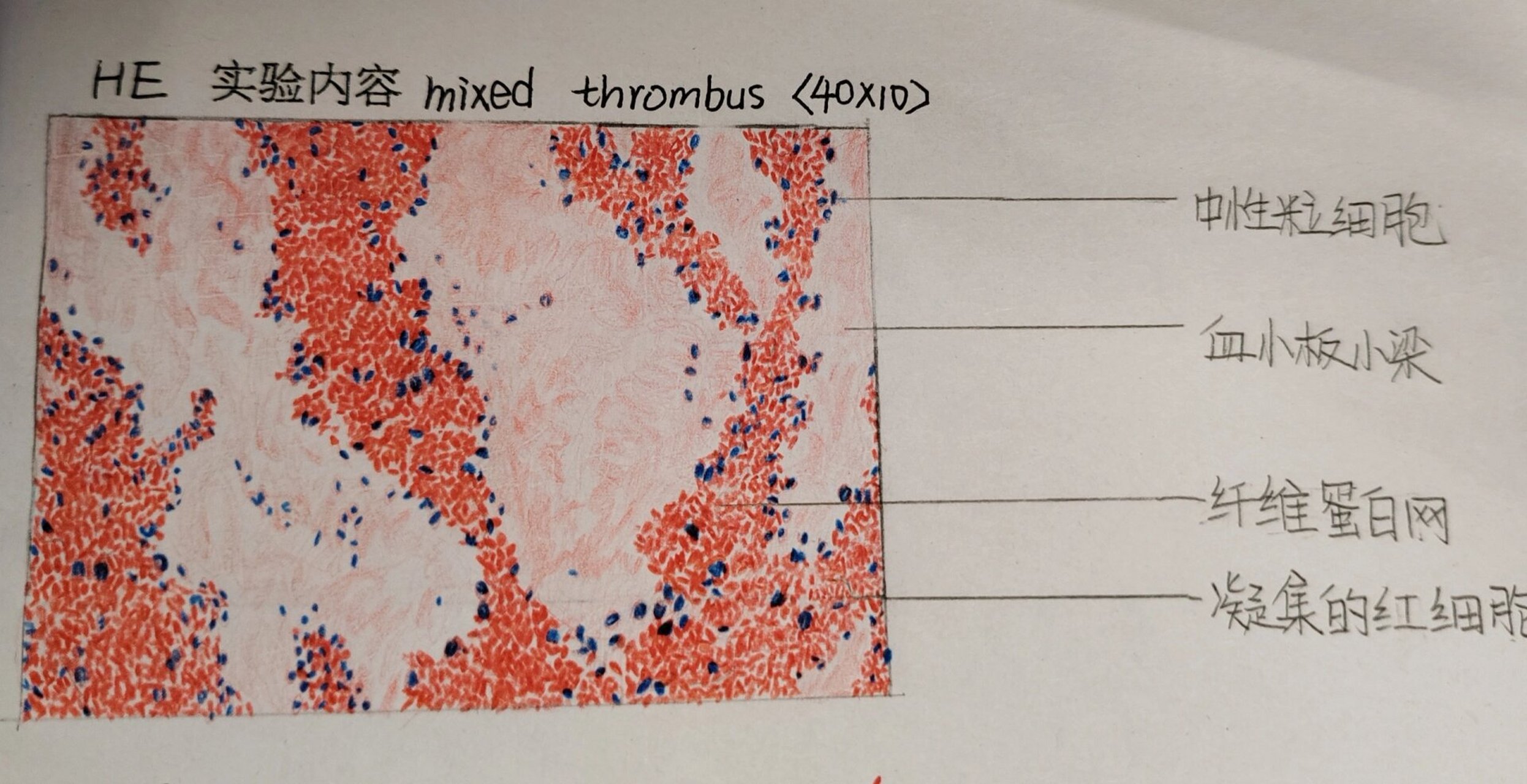 红蓝铅笔绘图病理混合血栓