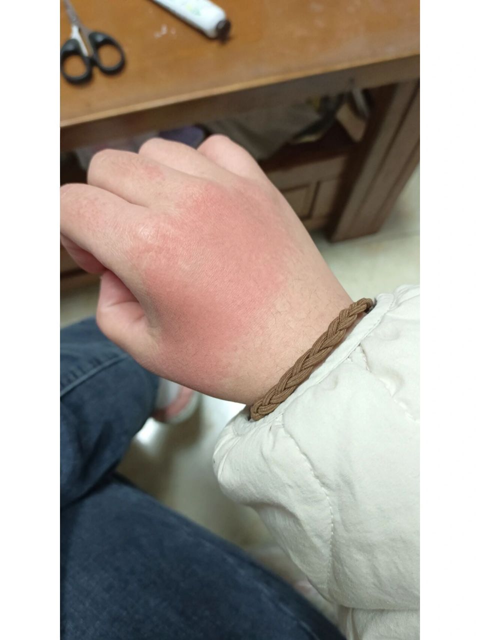 查了度娘,又说湿疹的蚊虫叮咬的过敏的 还有可能是冻伤的 有没有u有 