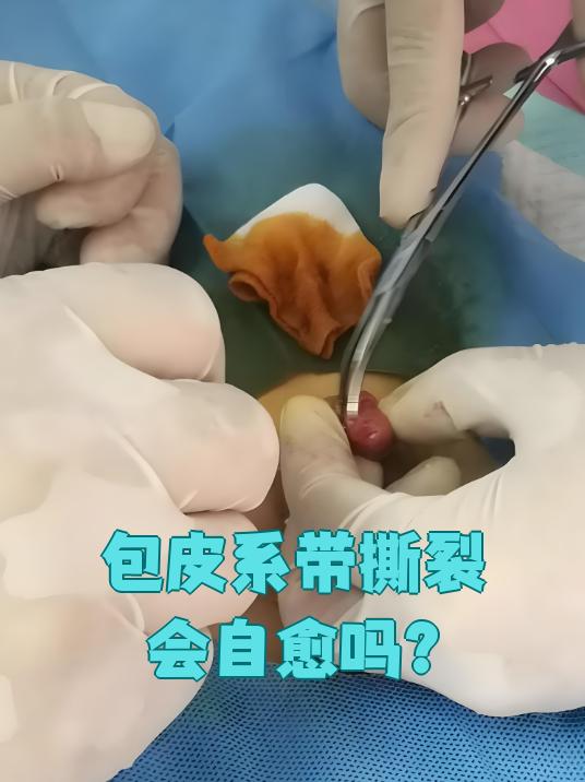包皮系带撕裂能不能自己好,主要看严重程度
