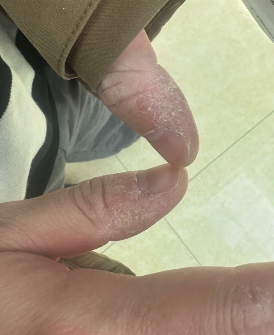 手指湿疹干裂脱皮需要根据具体情况选择治疗方法