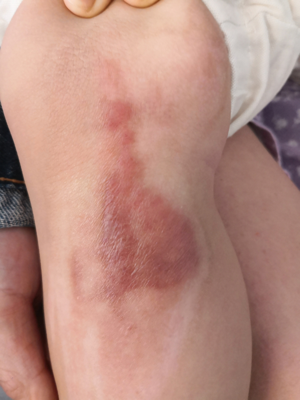 儿童小腿烫伤后的疤痕症状.