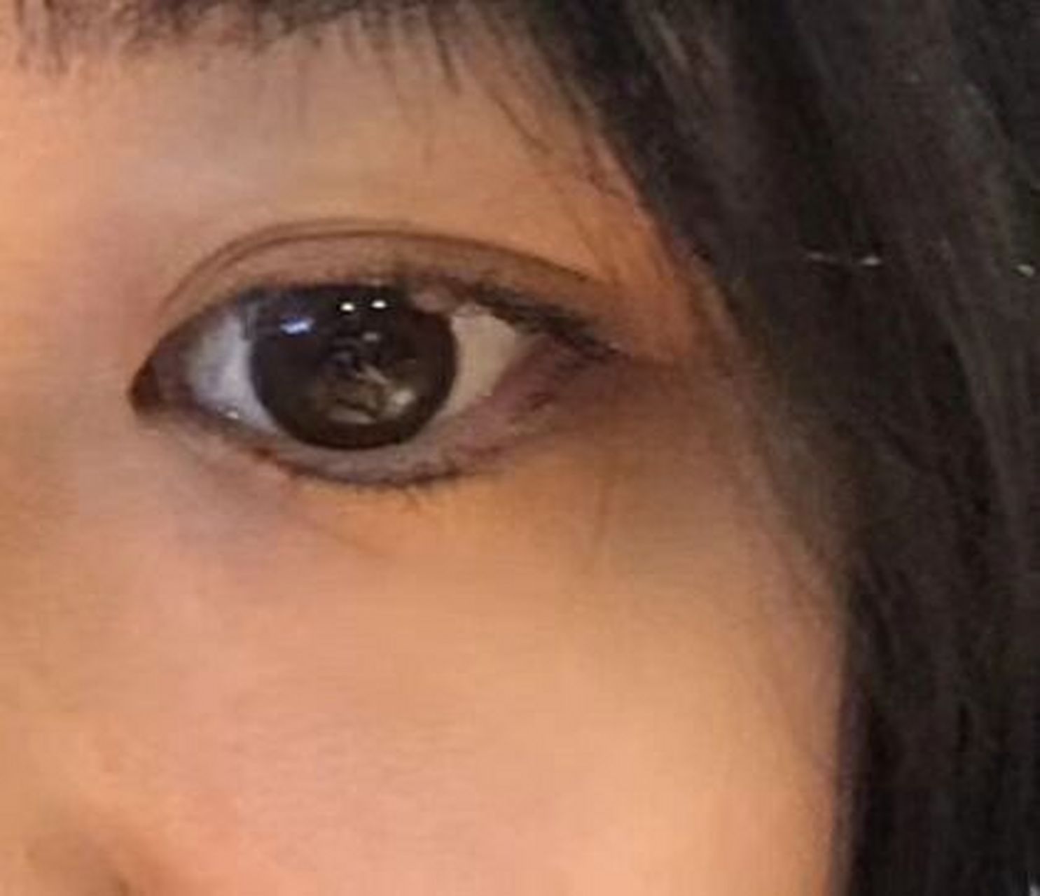 上眼睑痣 这颗痣长在右边上眼睑中间,因为害怕做掉之后眼眶会有缺损