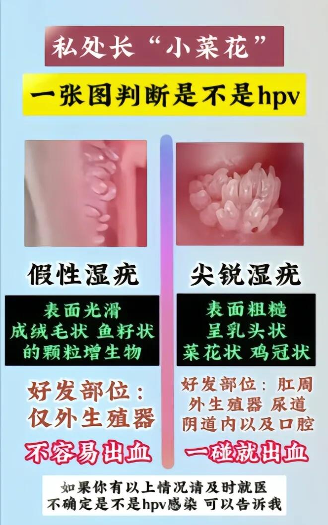 真假尖锐湿疣有没有hpv感染怎么判断⁉️