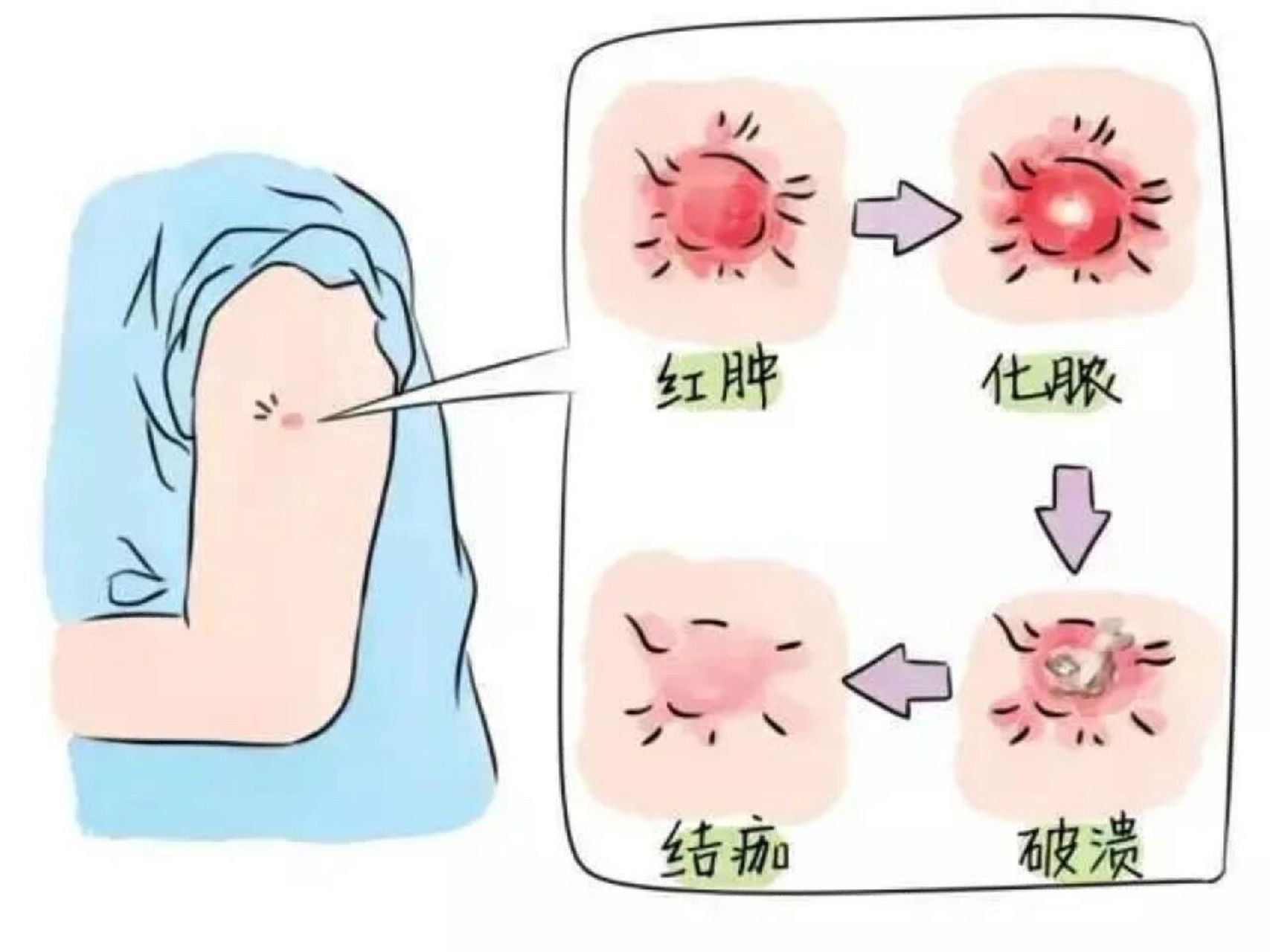 97卡介苗接种后注意事项(附脓包变化图) ①要保持局部的清洁干燥