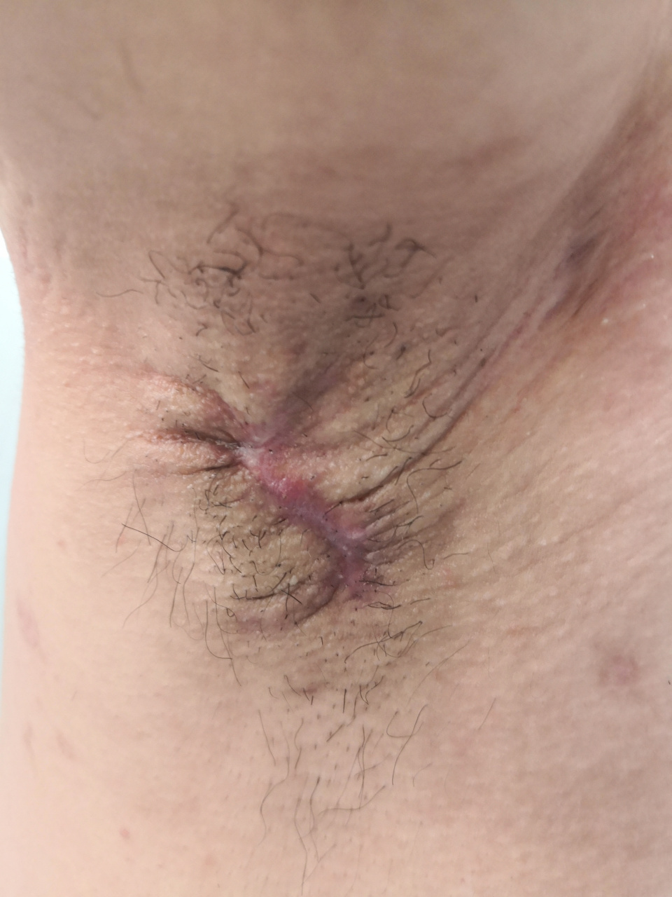 腋臭手术切除部分腋毛后的疤痕症状.