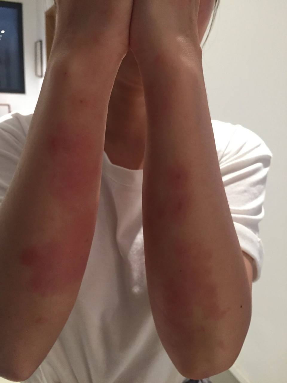 大漆过敏怎么办?