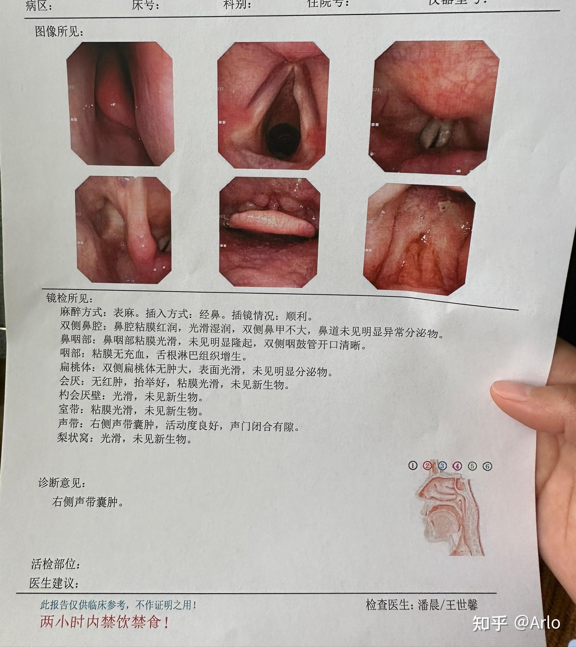 咽炎咽部囊肿图片图片