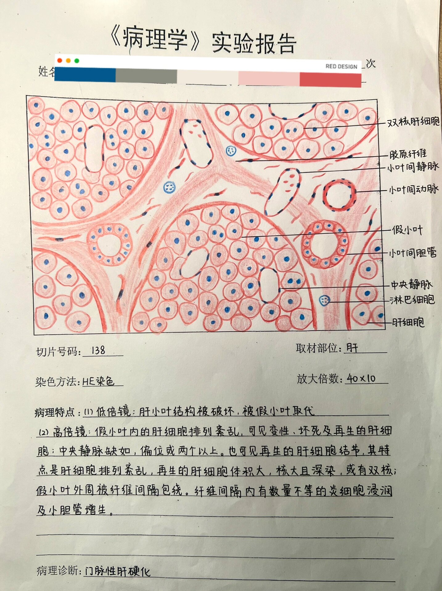 门脉性肝硬化10×10图片