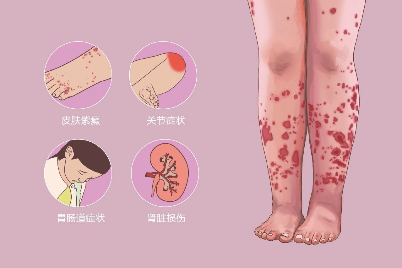 特发性血小板减少性紫癜的饮食建议主要围绕几点,请知悉.
