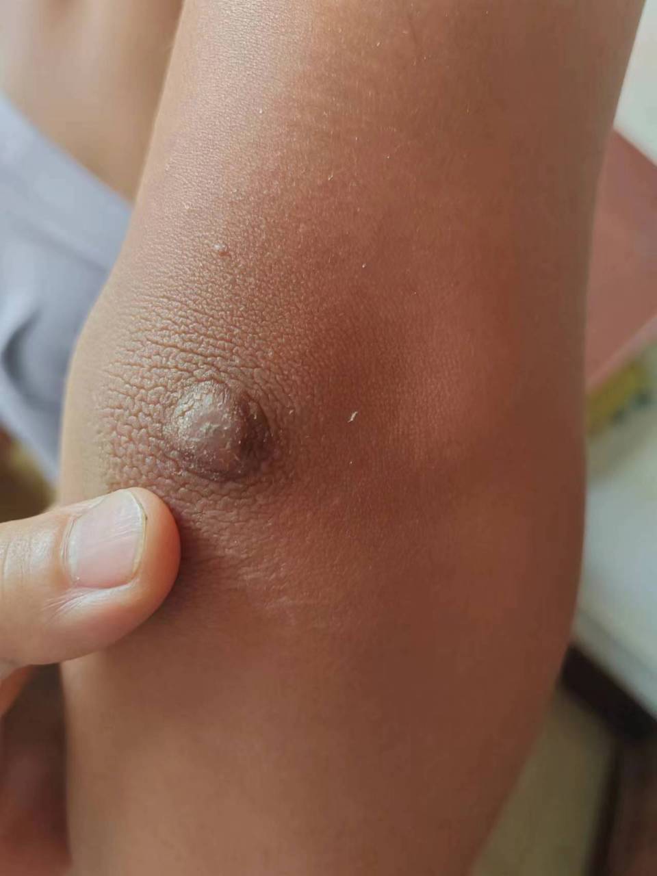 角化过度.考虑寻常疣.可以使用激光治疗切除活检.