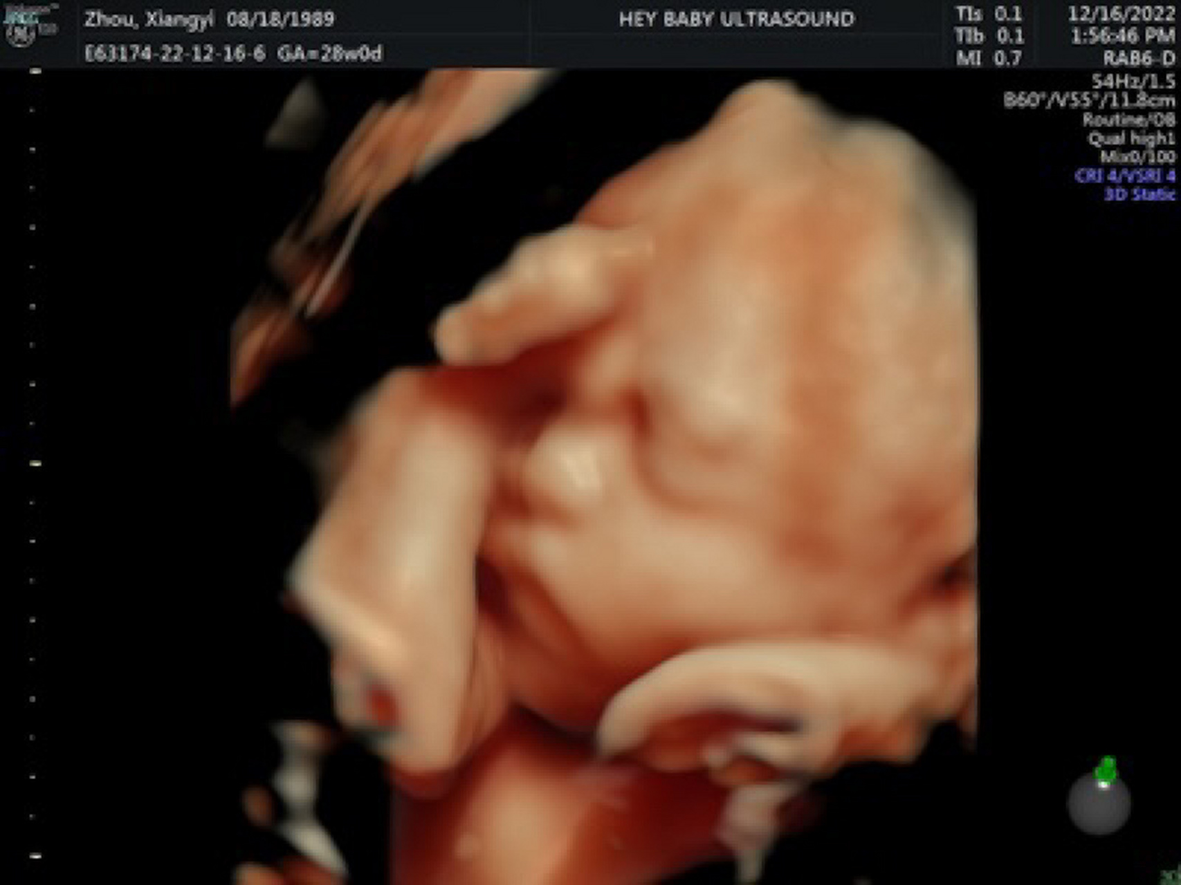 28周了,今天照了四维彩超,宝宝鼻子好大啊 其实我的大排畸一个多月之