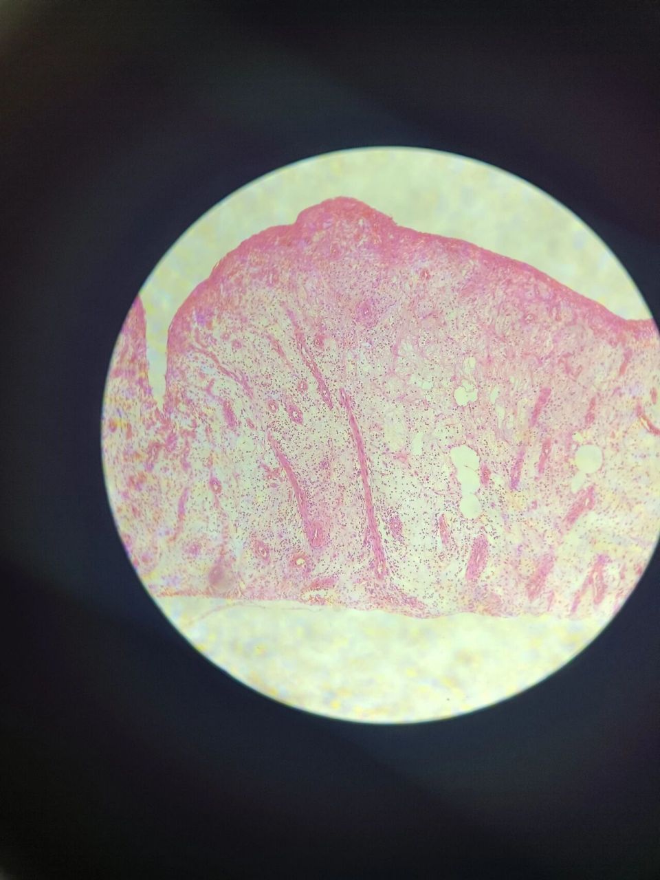 病理学红蓝铅笔绘图 肉芽组织