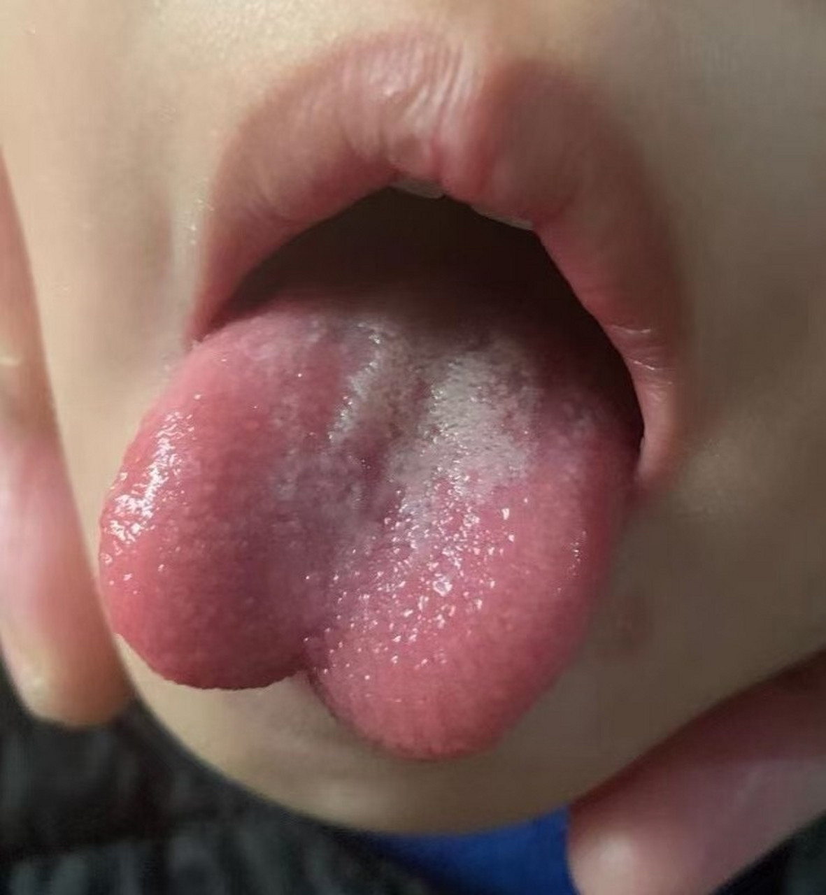 一个漂亮的桃心舌 实则问题很多 舌尖明显凹陷 说明心血严重不足