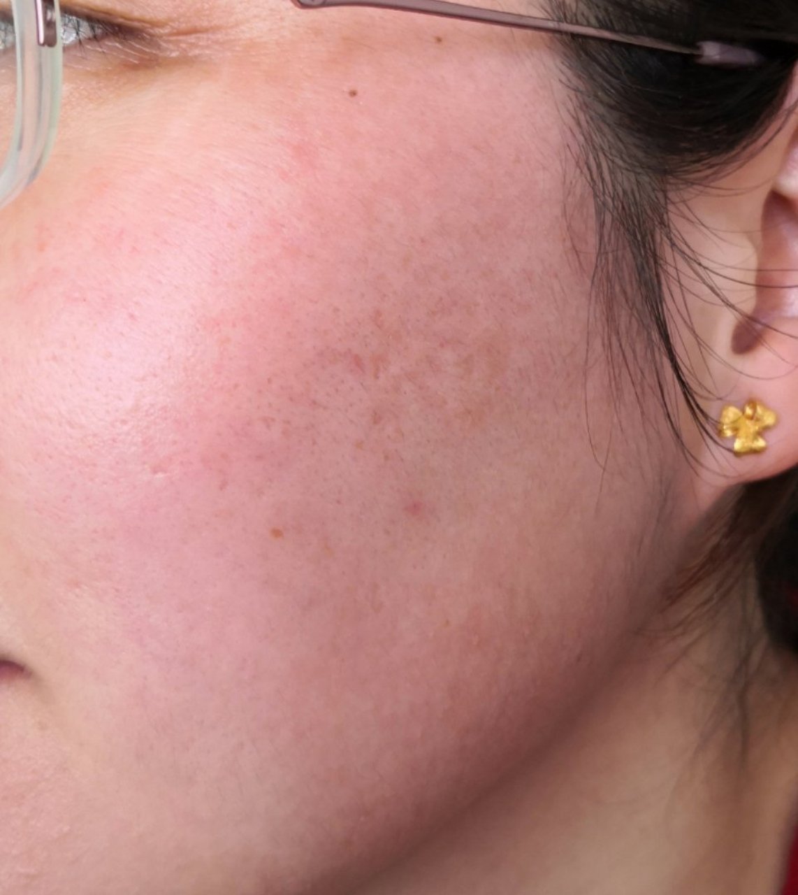 玫瑰痤疮红斑潮红症状.#玫瑰痤疮##红斑