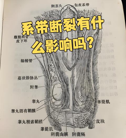 阴茎系带断裂后,最直接的影响就是疼痛和出血