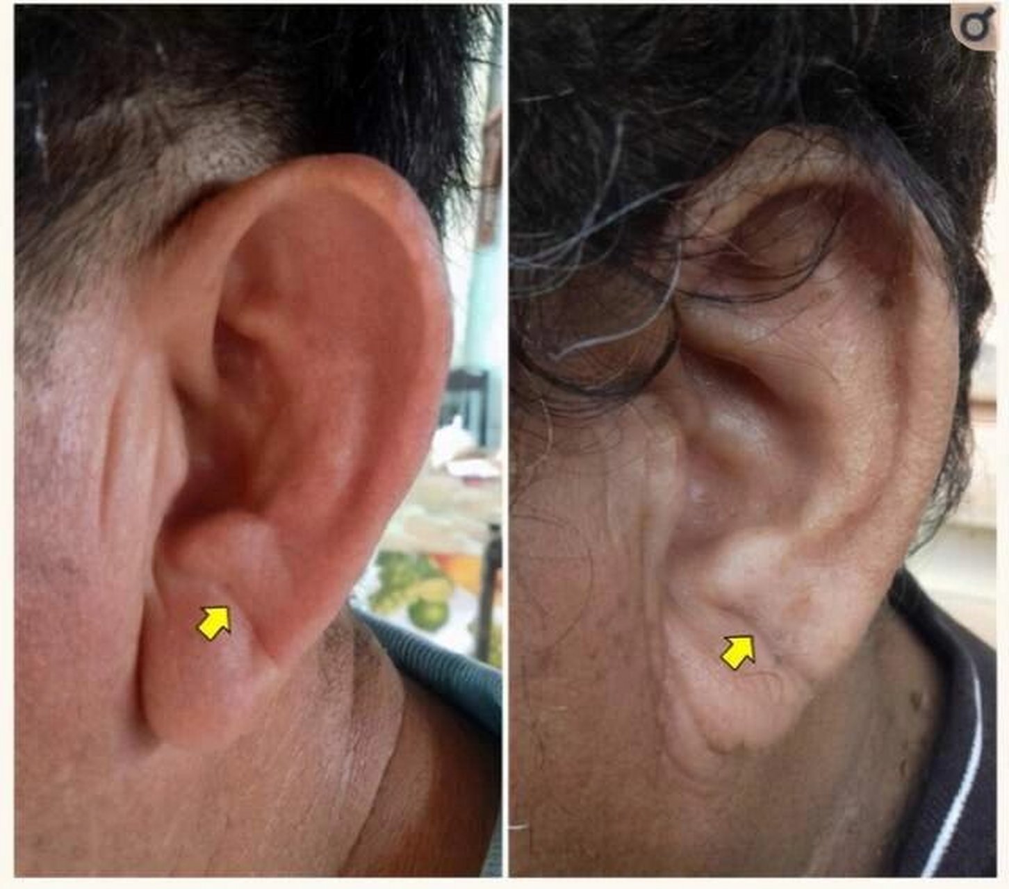 耳褶心征|耳垂出现褶皱一定要重视!🔥