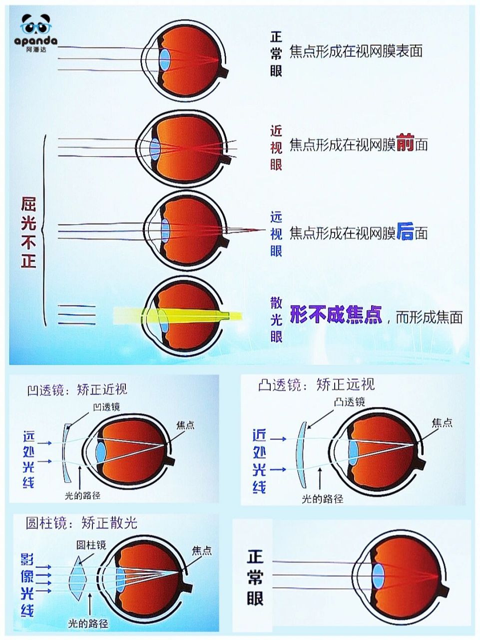 一图看懂近视,远视,散光的问题 快来看看这些你都了解过吗?