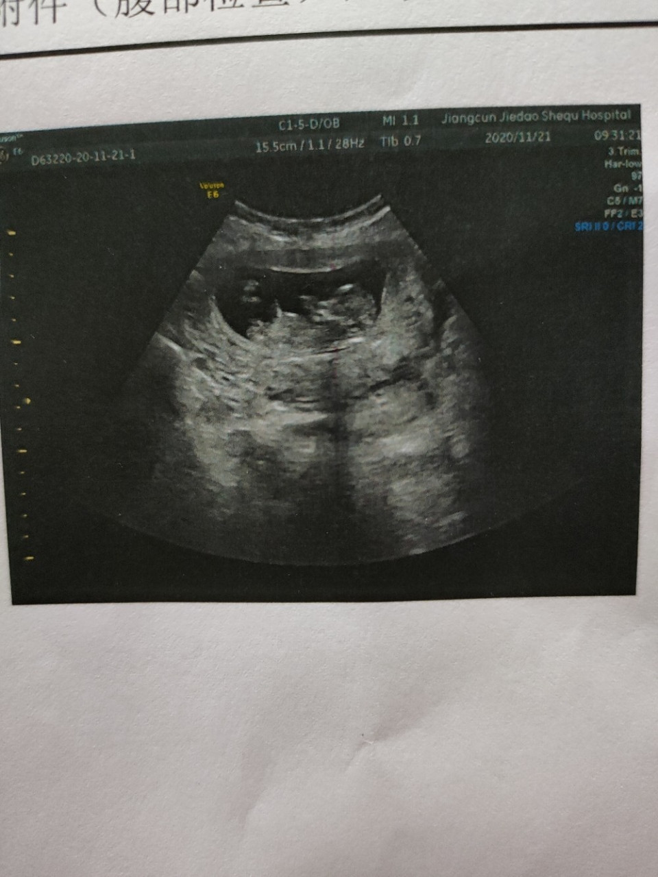 孕12周77,nt顺利过. 我早上步行四百米去医院的.