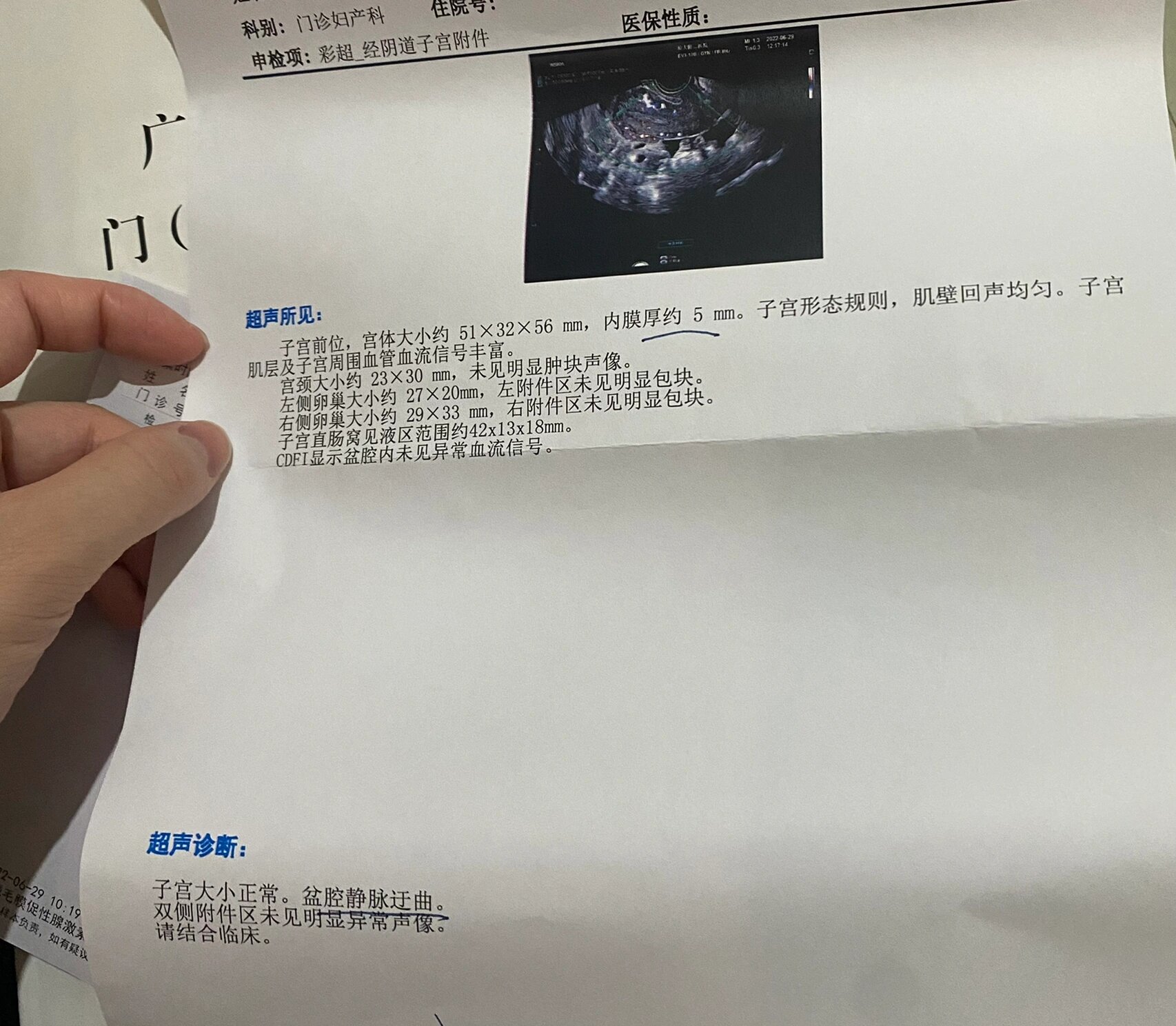 盆腔静脉曲张的姐妹,你们治好了吗 产后六个月来例假就不正常,不是