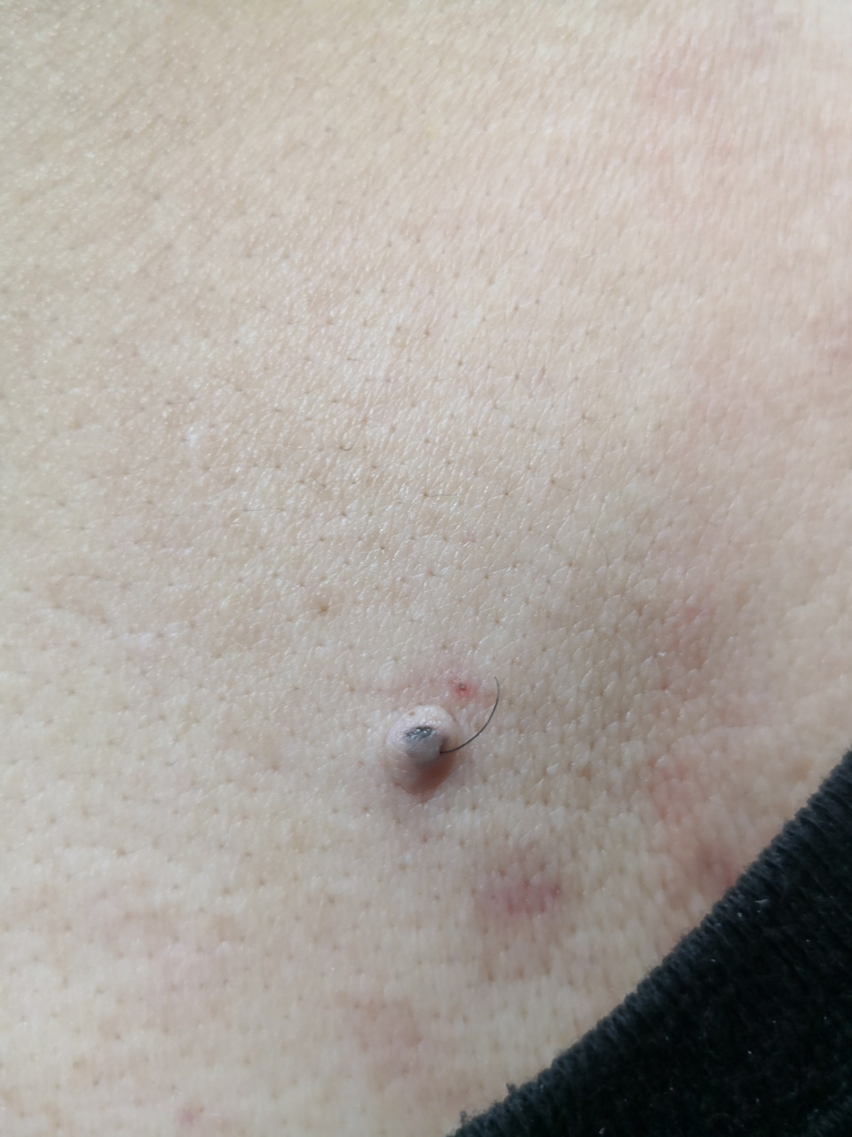 背部色素痣症状#解决皮肤问题专注皮肤美容# 需要活检