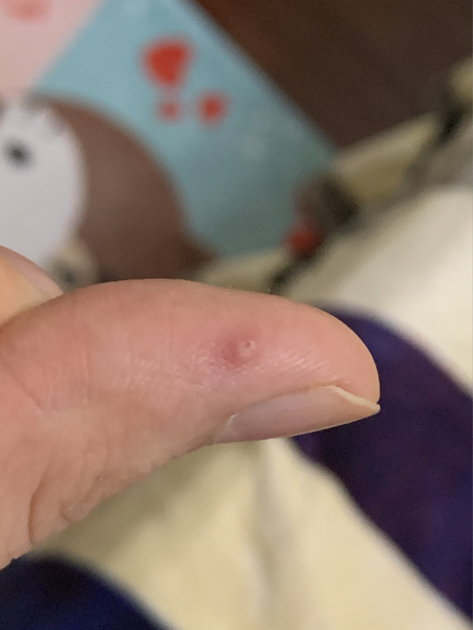 手上有小红点,不痒也不怎么疼 突然有一天,看到手指上有一个红点,长在