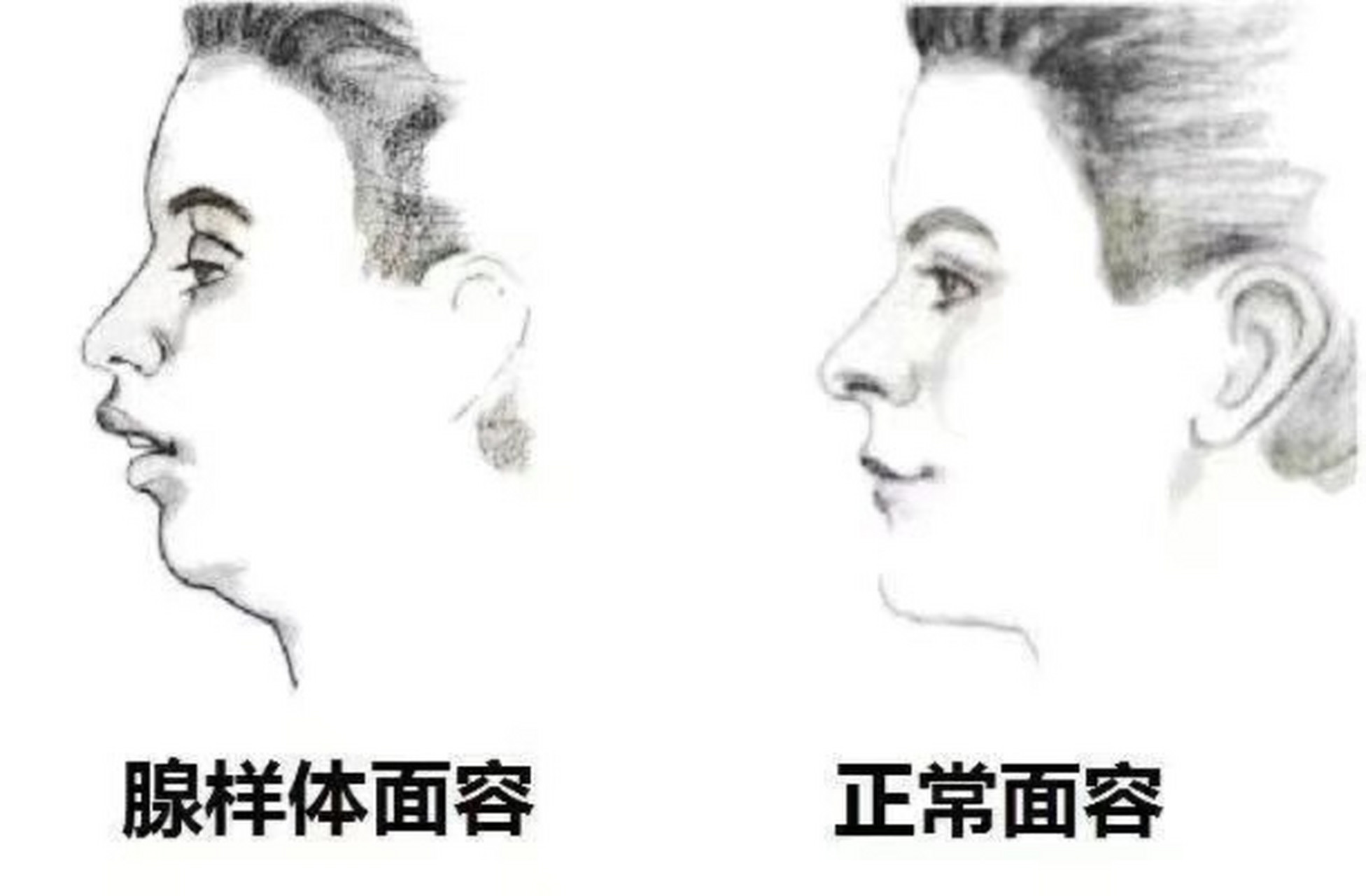 对比图片看下,你家宝宝有腺样体面容吗 腺样体肥大信号90 【孩子