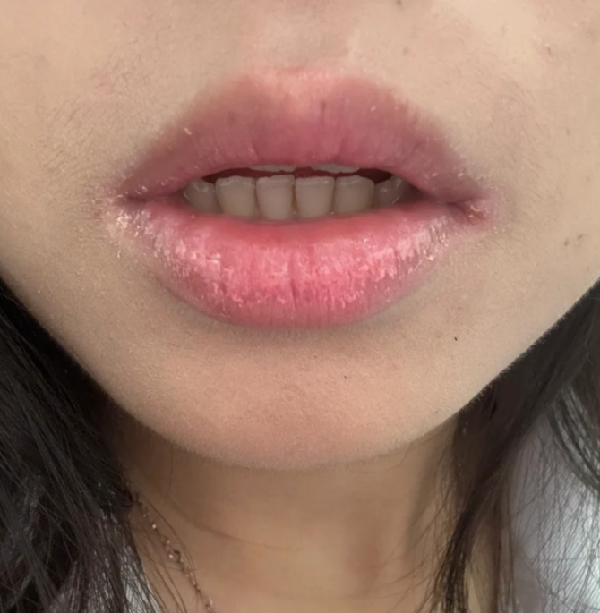 嘴唇干燥起皮常见原因有上火,接触性皮炎,剥脱性唇炎和缺乏维生素b