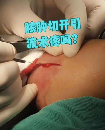 脓肿切开引流术确实会有些疼