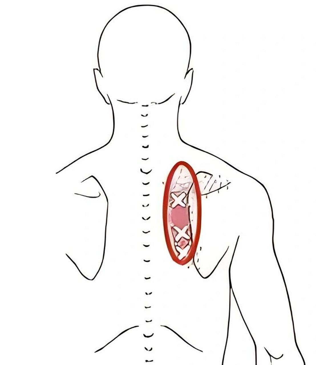 98中医薛老师今日分享:肩胛骨缝疼 很多人的肩胛骨缝这个位置疼,触