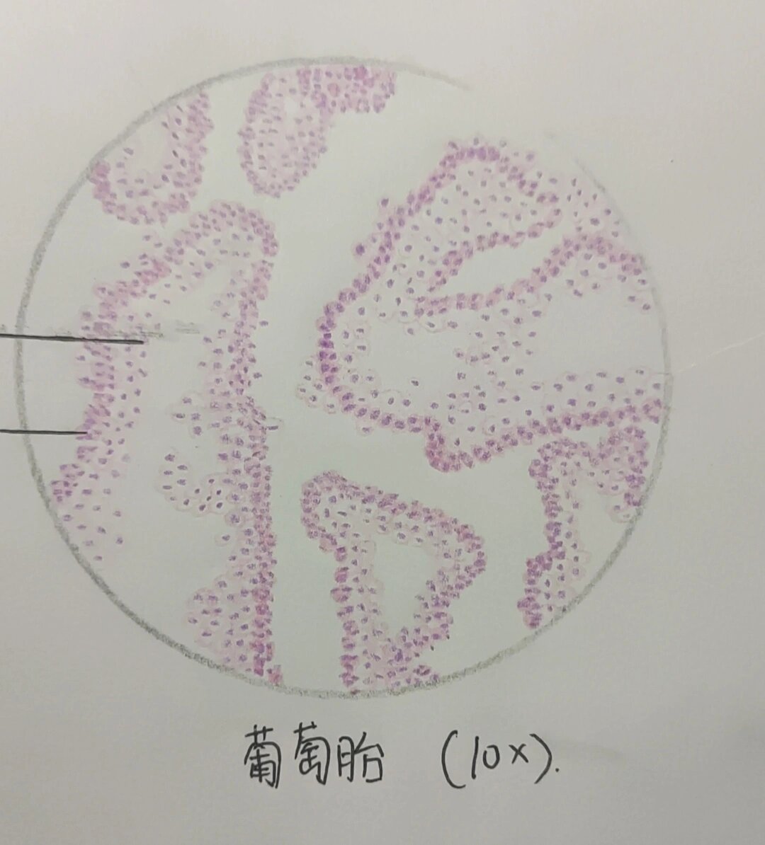 葡萄胎镜下图片手绘图片