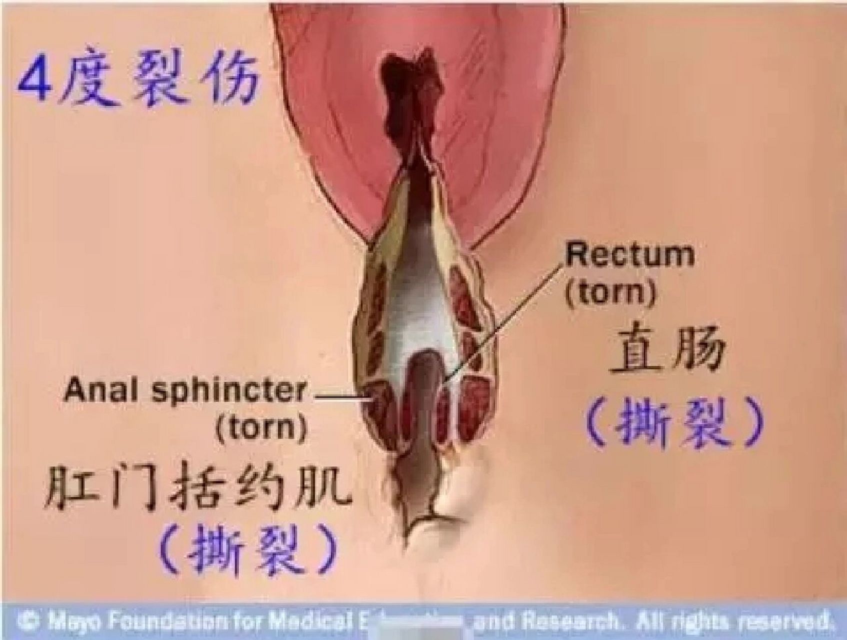 分娩照片撕裂图片