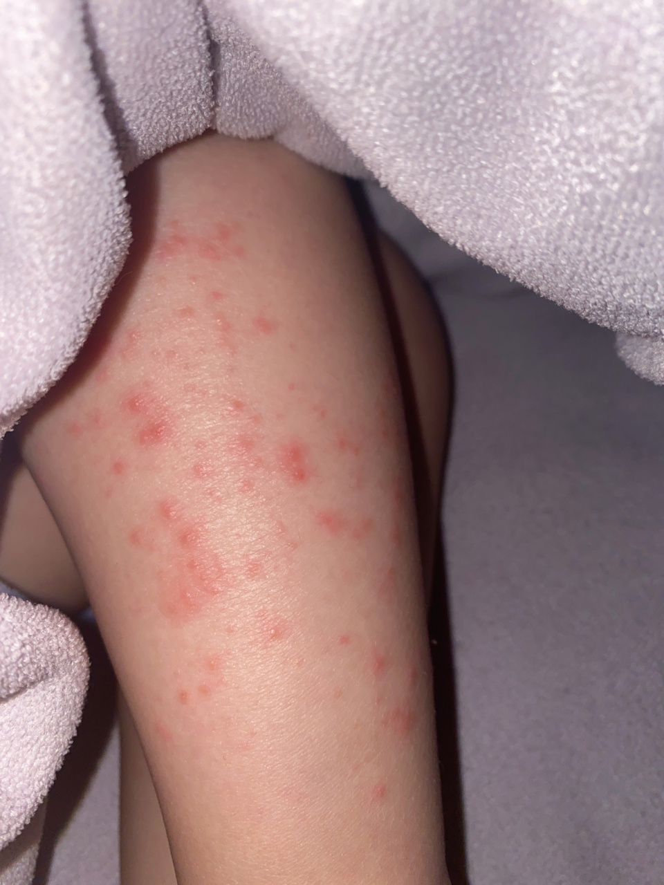宝宝小腿红疹,按压褪色,不痛不痒 宝宝3岁,晚上洗漱时候发现小腿上一