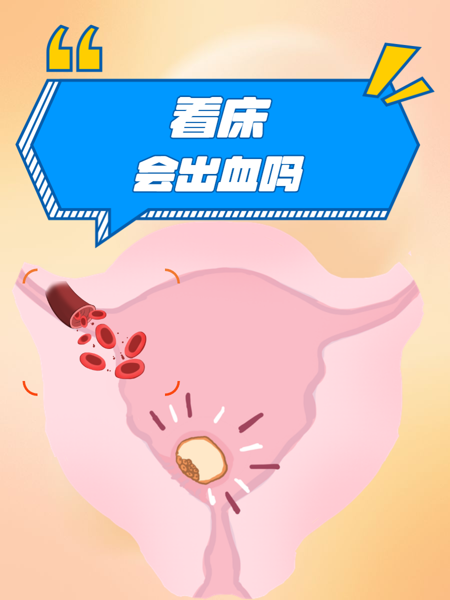 着床会出血吗?