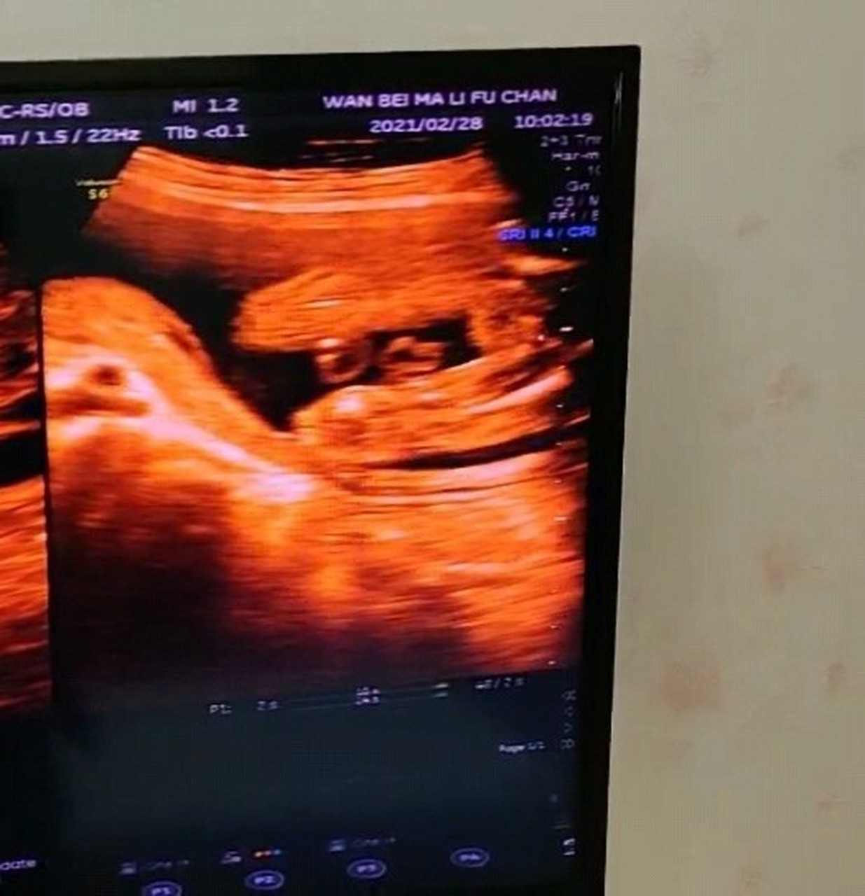 b超看男女,有会看的吗?23周的四维