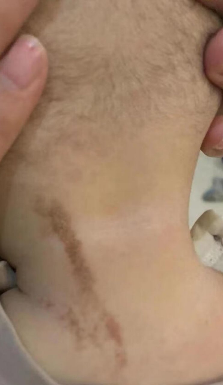 线性疣状表皮痣#激光美容