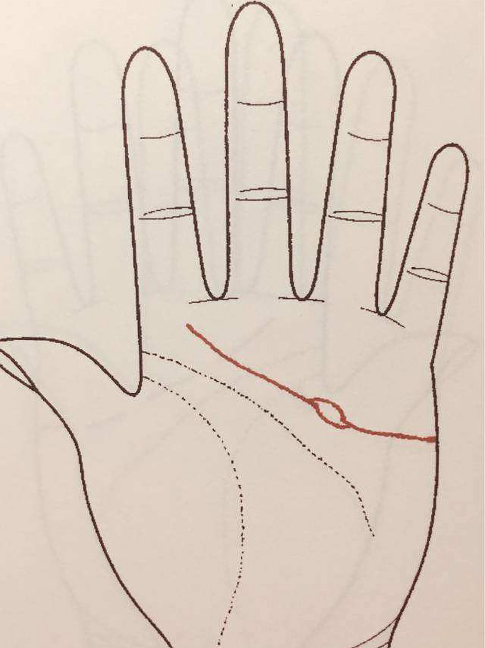 岛纹出现在掌纹上的寓意 1,岛纹在生命线上,代表着疾病缠身,是不健康