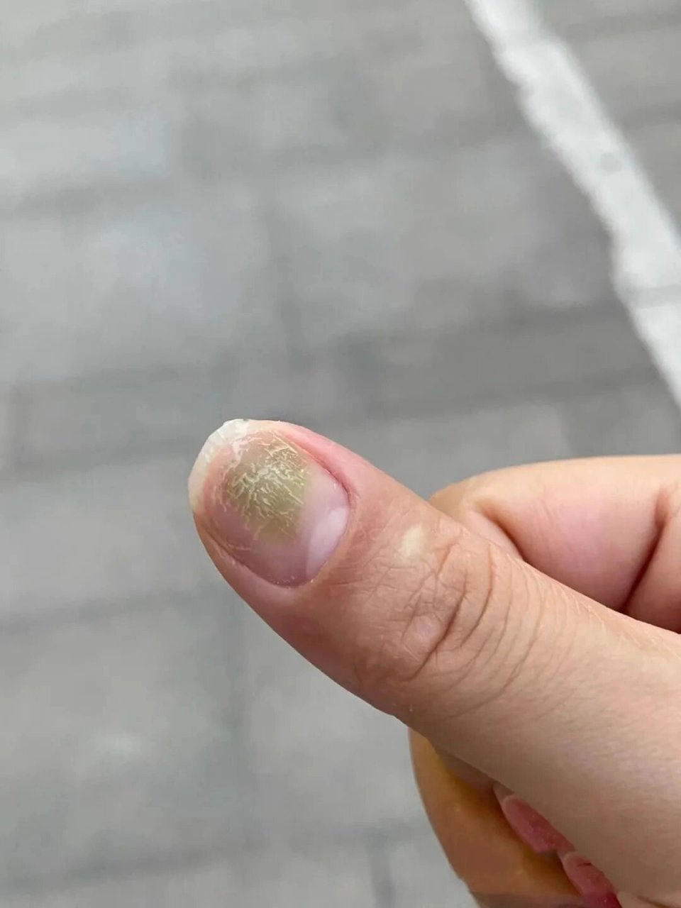 长春美甲|悦喜美甲科普篇-绿指甲绿脓杆菌 随着科技的发展,社会的进步