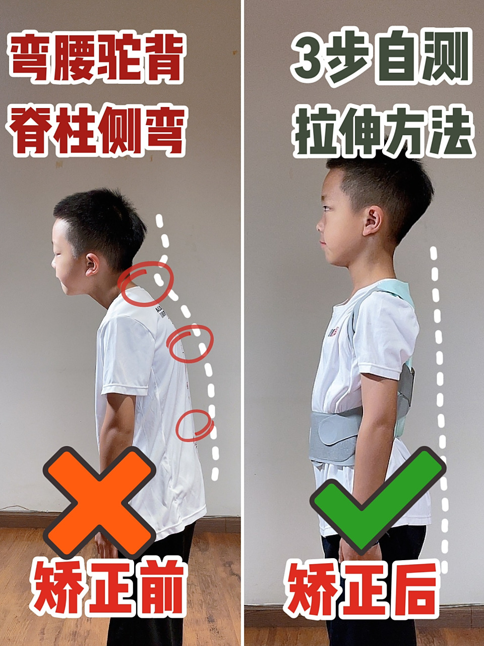 儿童 驼背(圆肩驼背 08含胸驼背),坐姿 站姿 不正,都容易形成贾柱