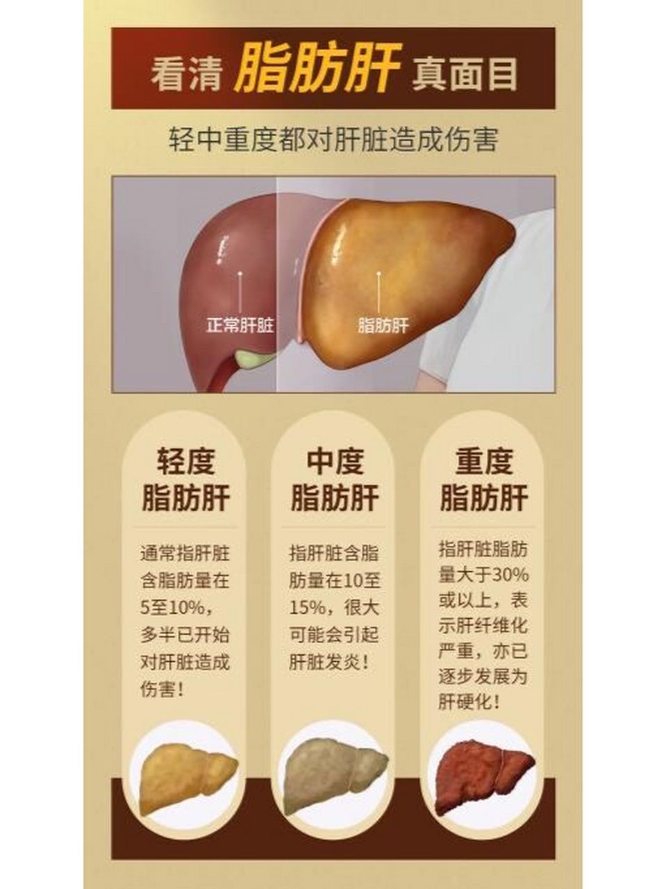 脂肪肝是一种值得重视的疾病: 您可能觉得轻度脂肪肝一般并没有什么