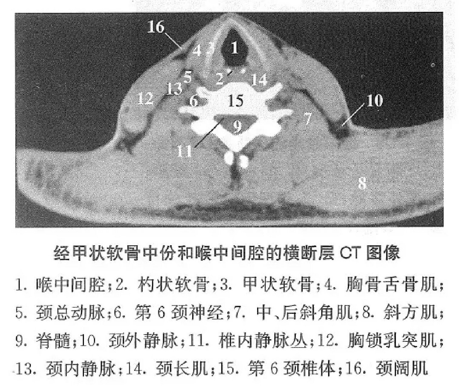 经甲状软骨中份和喉中间腔的横断层ct