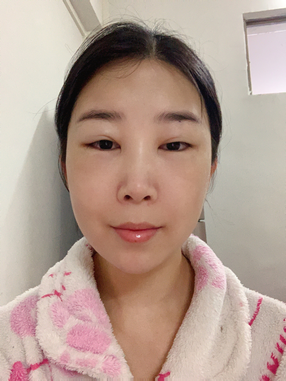 肾病综合征水肿到激素肿的过程 今天是吃药治疗的第5
