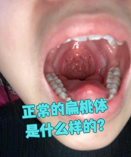 正常的扁桃体表面光滑,颜色是淡红色的,平时不会让人感到不舒服,也